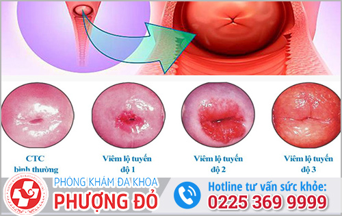 Các cấp độ của bệnh viêm lộ tuyến cổ tử cung và cách chữa trị