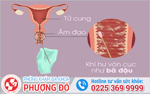 Cách chữa khí hư vón cục như bã đậu