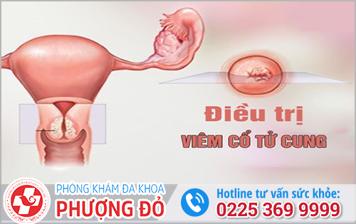 Điều Trị Viêm Cổ Tử Cung Hiệu Quả