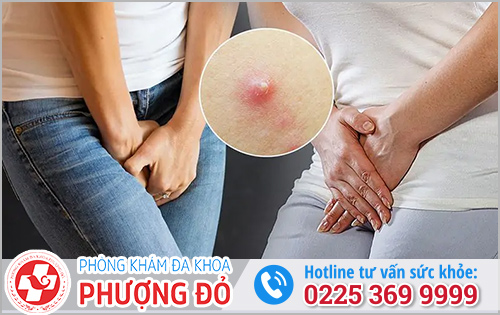 Mụn Vùng Kín Nữ Là Bệnh Gì? Dấu Hiệu Và Cách Điều Trị