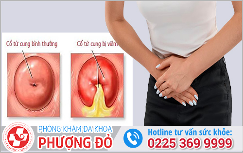 Nguyên nhân gây viêm lộ tuyến cổ tử cung và Cách chữa trị