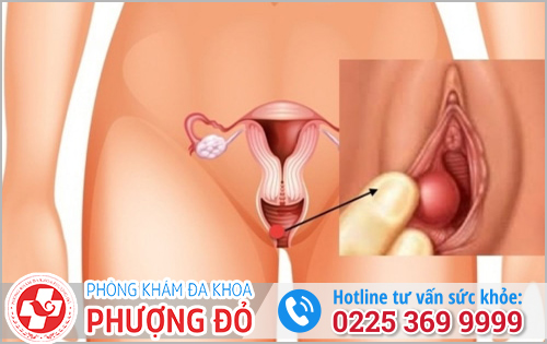 Sưng 1 bên mép vùng kín nguyên nhân và điều trị