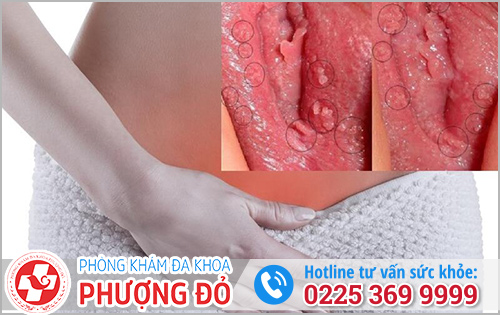 Thịt Dư Âm Đạo Vùng Kín Không Nên Xem Nhẹ