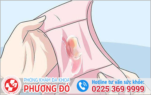 Âm đạo chảy mũ dấu hiệu bệnh lý