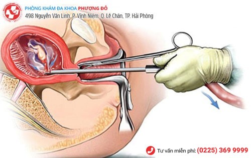 Bỏ thai an toàn theo tuần tháng tại Đa Khoa Phượng Đỏ