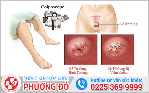 Vì sao cần điều trị sớm viêm lộ tuyến?