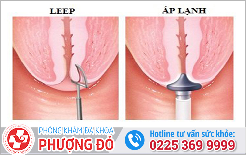 Chữa viêm lộ tuyến cổ tử cung bằng phương pháp đốt