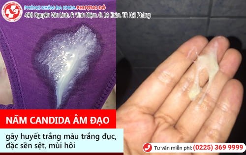 Nấm candida âm đạo: Dấu hiệu nhận biết và cách chữa trị hiệu quả