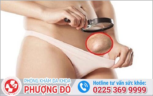 Bệnh Lý Thường Gặp Gây Hạch Vùng Kín