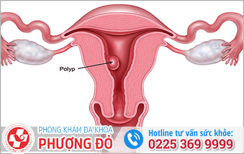 Hỗ trợ điều trị polyp cổ tử cung bằng cách nào khả quan?