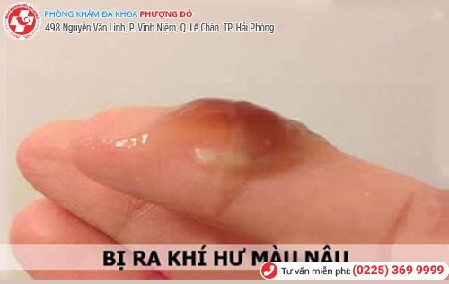 Khí hư ra nhiều: Đừng chủ quan kẻo mắc bệnh trọng