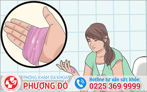 Khí hư tiết dịch như sữa chua nguyên nhân và điều trị