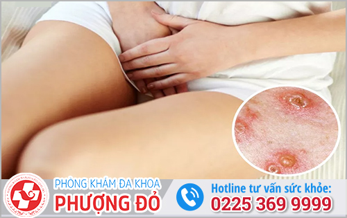 Nổi mụn ở vùng kín nữ là bệnh gì?