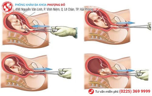 Nạo thai – hãy chủ động để không phải hối tiếc