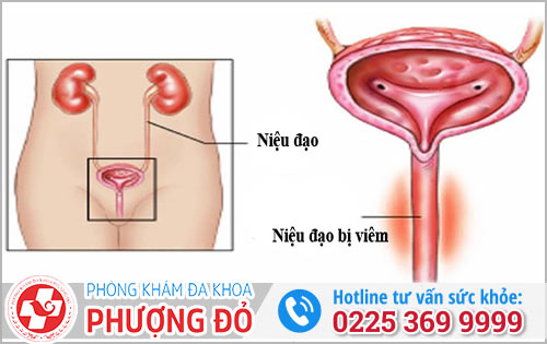 Nhận biết dấu hiệu viêm niệu đạo?