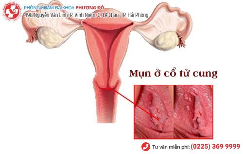 Nổi mụn cổ tử cung là bị gì?