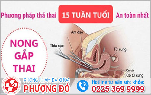 Phương pháp phá thai 15 tuần