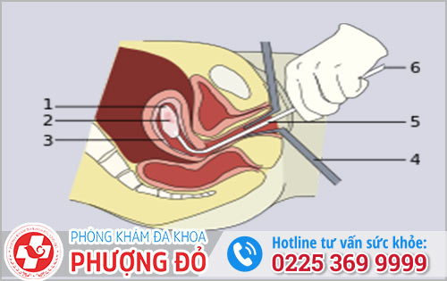 Quy trình nong gắp thai 16 tuần 