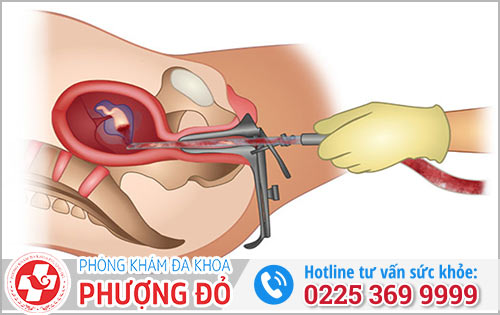 Những Cách Phá Thai 19 Tuần