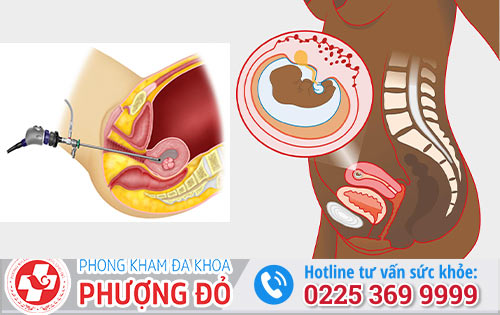 Phá Thai 8 Tuần Tuổi Bằng Phương Pháp Nào An Toàn