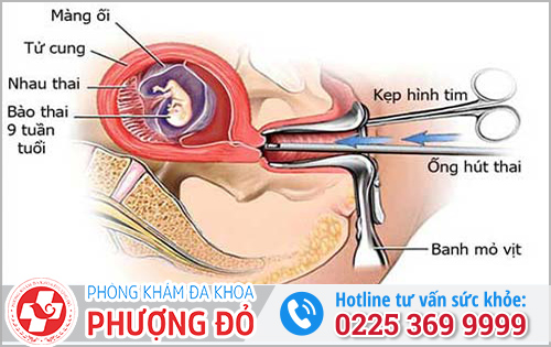 Thai 9 tuần nên phá bằng cách nào?