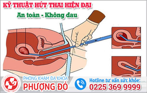 Phá Thai Từ 4  Đến 8 Tuần Bằng Phương Pháp Nào An Toàn