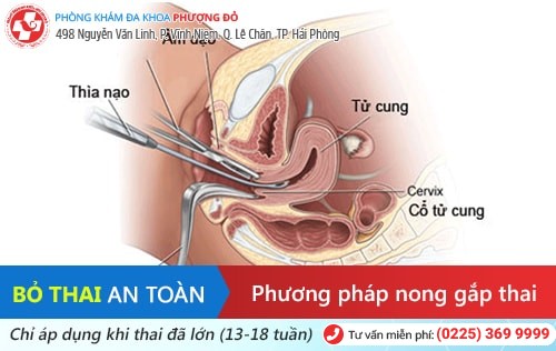 Bỏ thai bằng phương pháp nào an toàn?