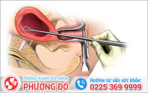 Phương Pháp Phá Thai 6 Tuần An Toàn Và Hiệu Quả