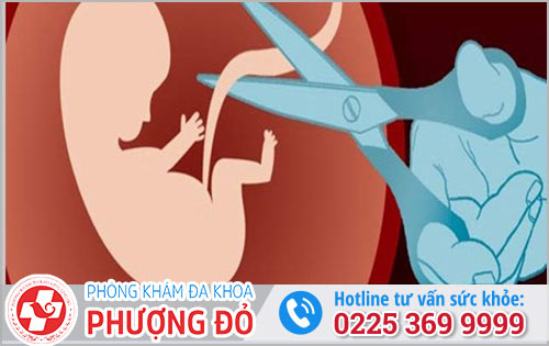 Phương pháp phá thai Kovax thực hiện như thế nào?