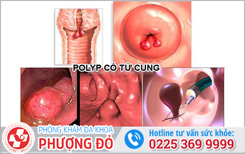 Polyp Cổ Tử Cung