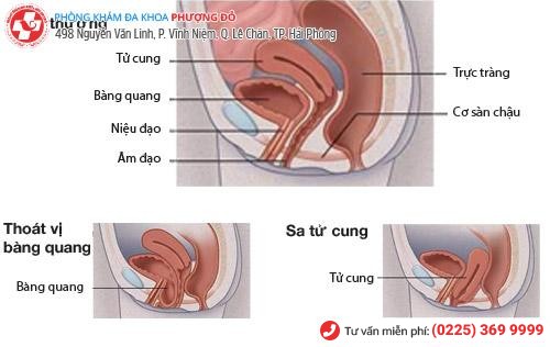 Sa cổ cử cung có ảnh hưởng gì không?