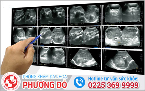 Siêu âm bụng phát hiện bệnh gì?