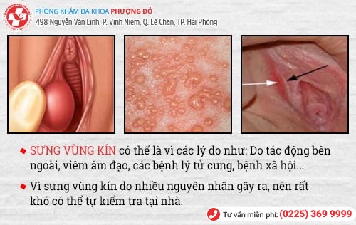 Sưng vùng kín: Nguyên nhân và cách điều trị hiệu quả