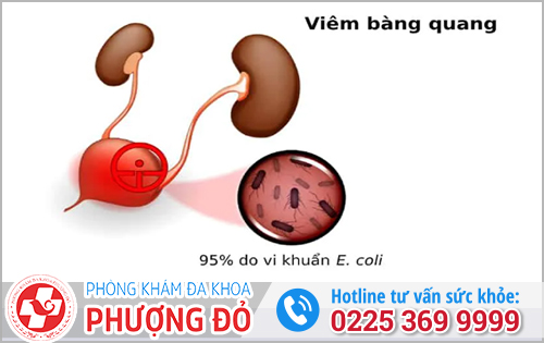 Viêm bàng quang có dấu hiệu gì? 
