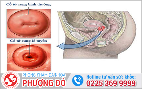 Mẹ bầu nên làm gì khi bị viêm lộ tuyến?