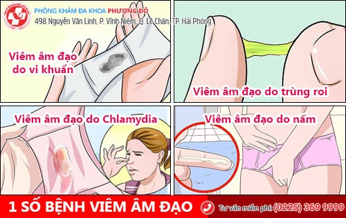 Các bệnh âm đạo thường gặp và cách phòng tránh