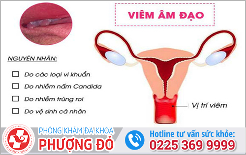 Nguyên nhân khiến chị em dễ mắc viêm phụ khoa