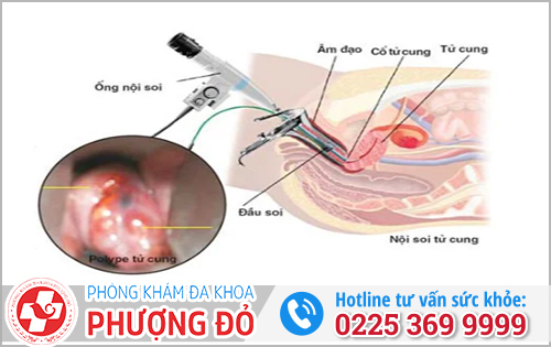 Phương Pháp Điều Trị Viêm Tử Cung